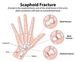 Scaphoid Fracture