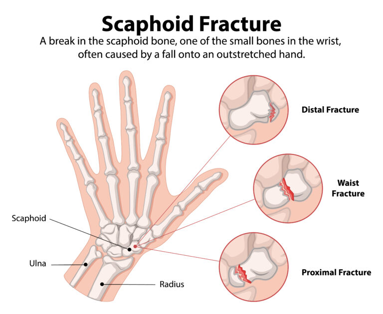 Scaphoid Fracture