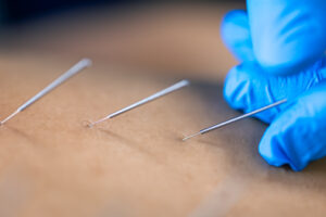 Dry Needling
