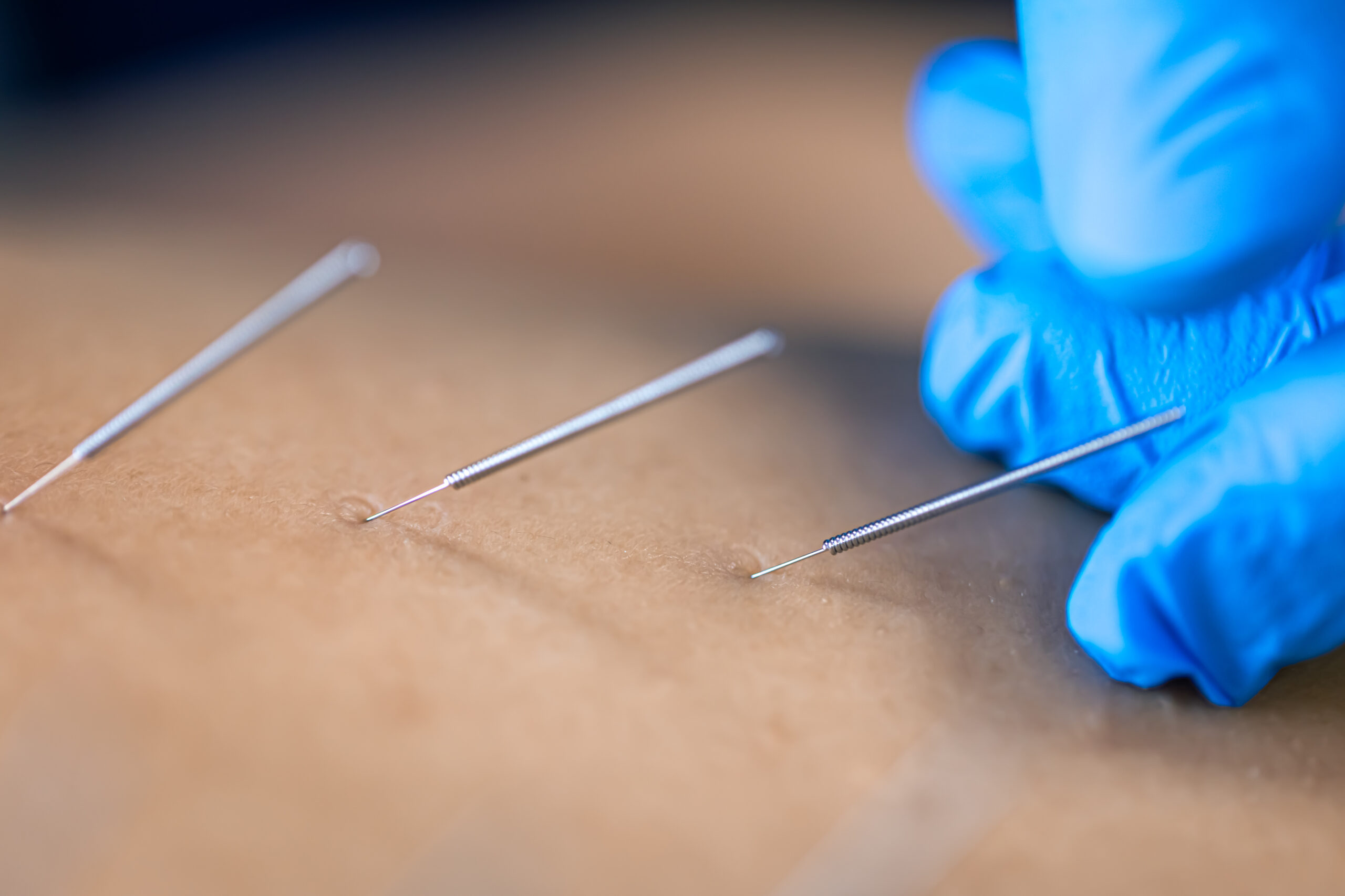 Dry Needling – What it Actually Does and Doesn’t do